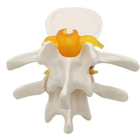 lumbar disc herniation spine model price