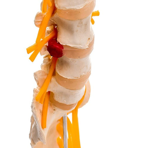 lumbar sacrum spine model with herniated dIsc medansh