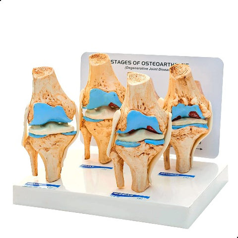 knee joint arthritis model price