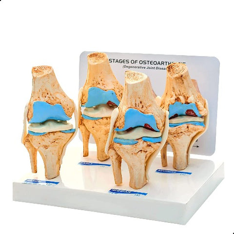 Knee Joint Arthritis Model 4 Stage Osteoarthritis – Medansh