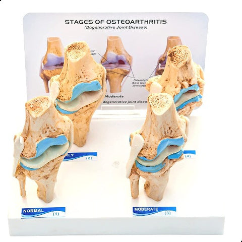 knee joint arthritis model meddey
