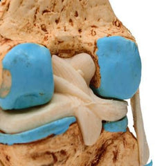 knee joint arthritis model medansh