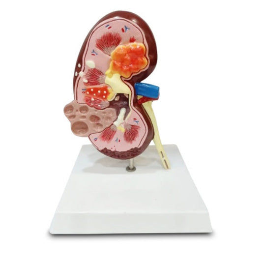 _kidney_cyst_model_delux_meddeygo