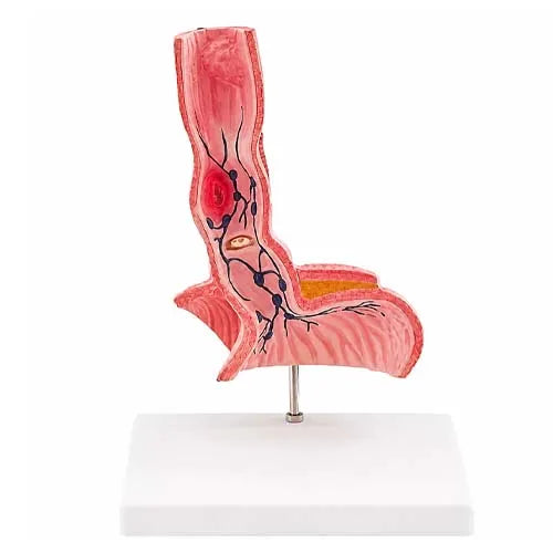 Ddseased esophagus model 