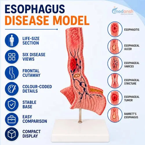 Ddseased esophagus model 
