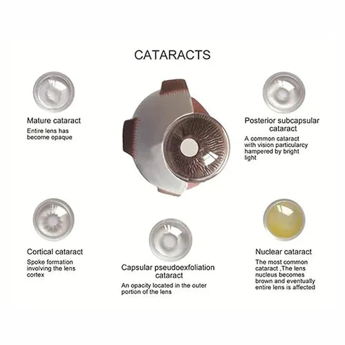 cataract_eye_model