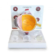 cataract_eye_model