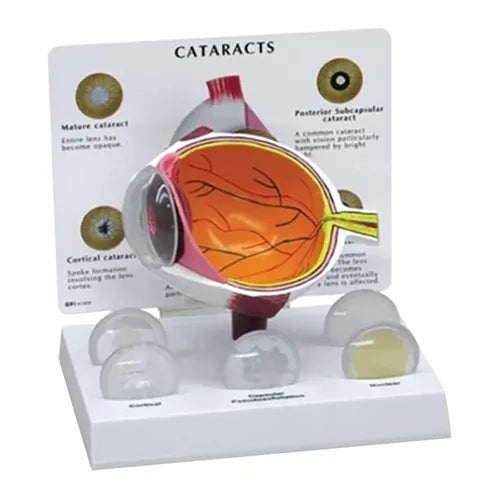 cataract_eye_model