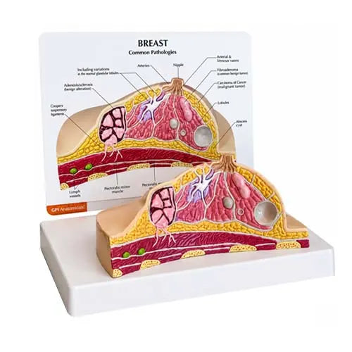 diseased breast model 