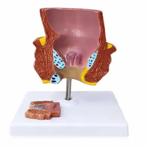 diseased rectum model