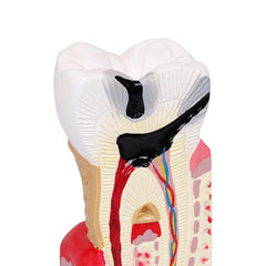 Diseased Tooth Model