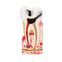 Diseased Tooth Model