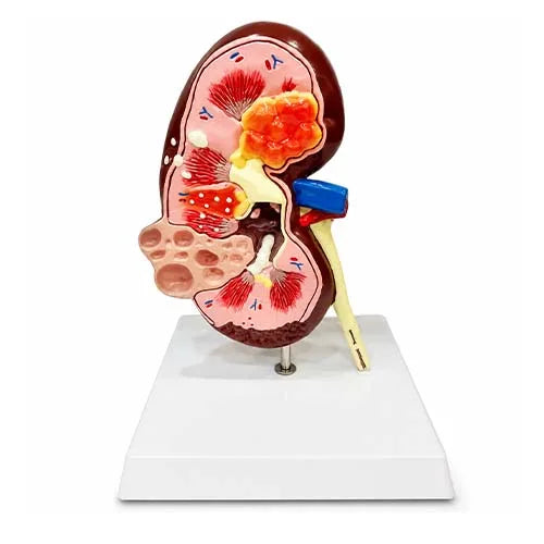 kidney cyst model