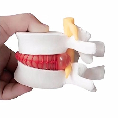 lumbar disc herniation spine