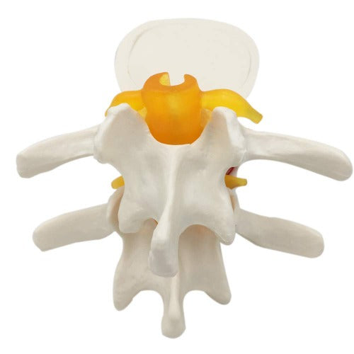 lumbar disc herniation spine