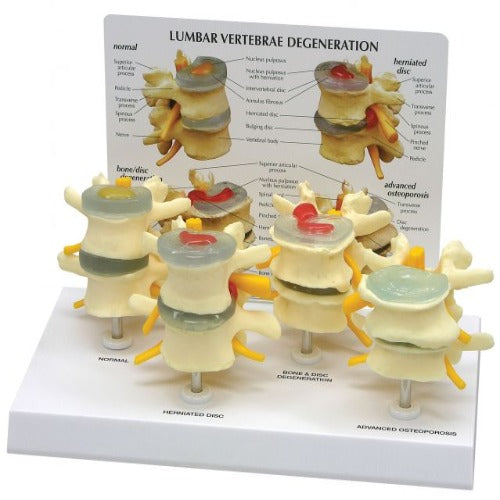 lumbar vertebrae degeneration model