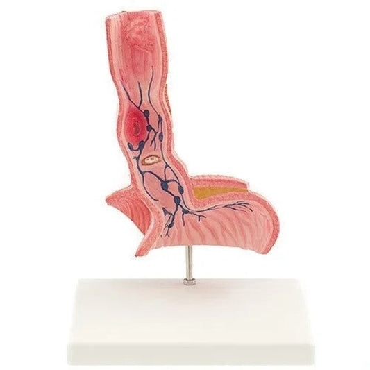 diseased esophagus model