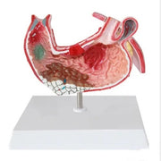 diseased stomach model