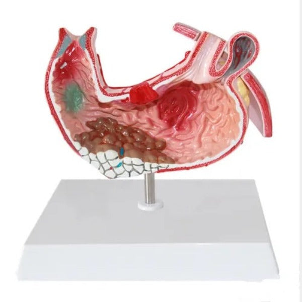 diseased stomach model
