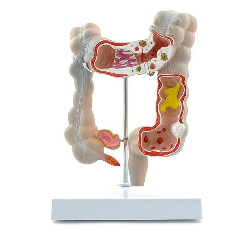 Colon Pathalogical Model